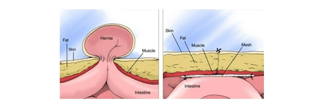 8-Laparoscopic Hernia Repair-dr-arindam https://gastrosurgeondubai.com/wp-content/uploads/2026/01/8-Laparoscopic-Hernia-Repair-dr-arindam.png