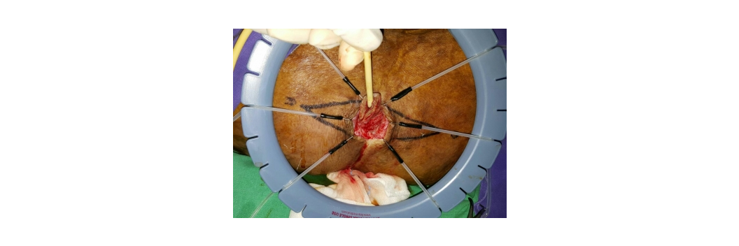 9-Proctology-Fissure, Fistula & Hemorrhoids-dr-arindam https://gastrosurgeondubai.com/wp-content/uploads/2026/01/9-Proctology-Fissure-Fistula-Hemorrhoids-dr-arindam.png