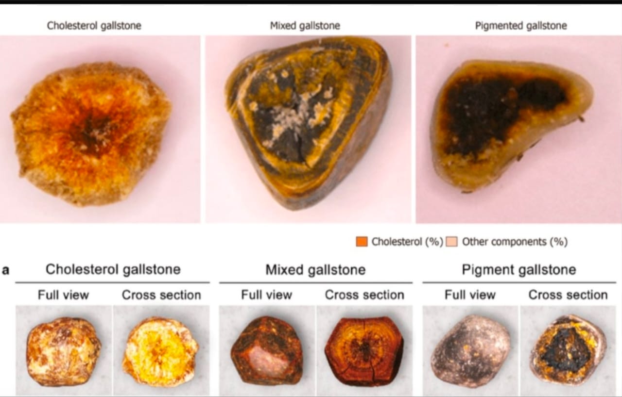 Gallstones Gallstones